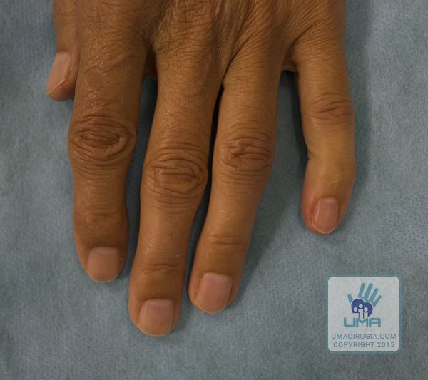 Cirugía de la mano en la Unidad de la Mano de A Coruña: Deformidad de la articulación interfalángica distal IFD con desviación hacia el borde radial