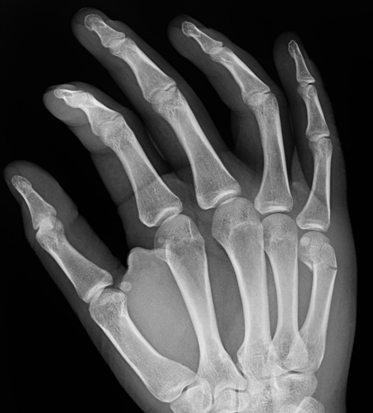 Casos Clinicos de la Unidad de Cirugía de la Mano A Coruña: Traumatismo con objeto romo sobre nudillo del 5º dedo de la mano derecha