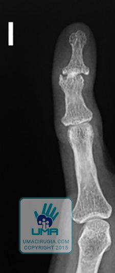Cirugía de la mano en la Unidad de la Mano de A Coruña: Osteofito artrósico y deformidad de la articulación IFD