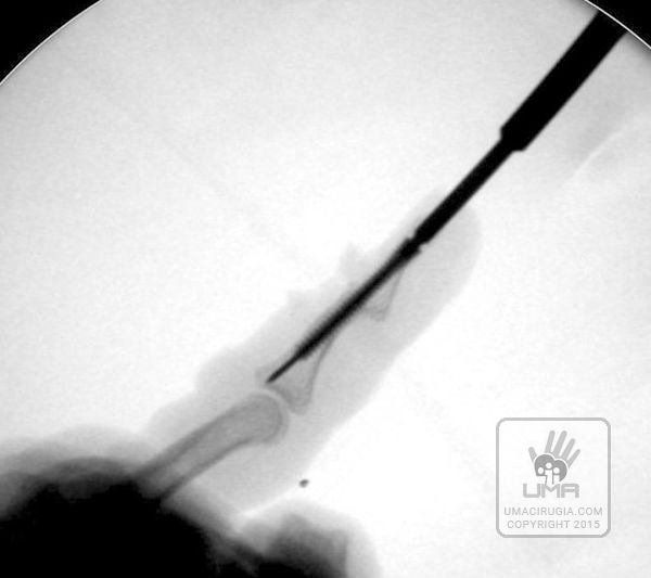 Cirugía de la mano en la Unidad de la Mano de A Coruña: Posicionamiento del tornillo AK proyección lateral
