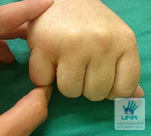 Cirugía de la mano en la Unidad de la Mano de A Coruña: Postoperatorio tras 1 mes, sin bostezo
