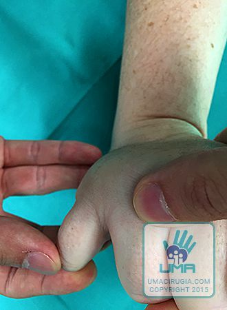 Cirugía de la mano en la Unidad de la Mano de A Coruña:Precirugía