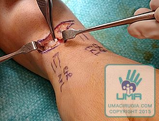 Cirugía de la mano en la Unidad de la Mano de A Coruña: liberados los tendones, se levantan dos colgajos con el tejido fibroso del techo del compartimento extensor