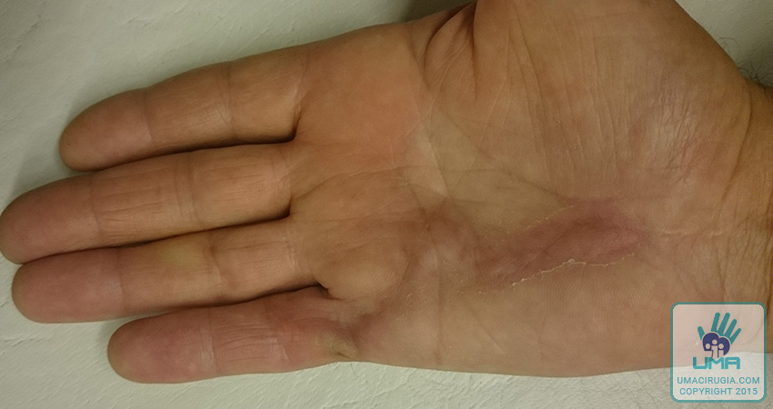 Cirugía de la mano en la Unidad de la Mano de A Coruña:Retirada de suturas y cicatrización