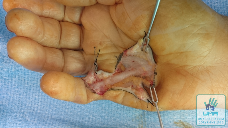 Cirugía de la mano en la Unidad de la Mano de A Coruña:Disección minuciosa y extirpación de las cuerdas fibrosas