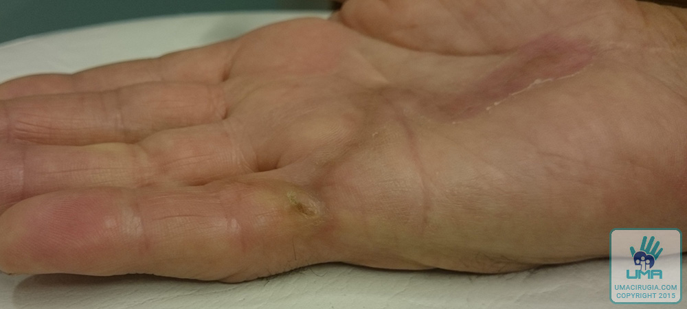 Cirugía de la mano en la Unidad de la Mano de A Coruña:buena extensión del dedo, sin hematomas