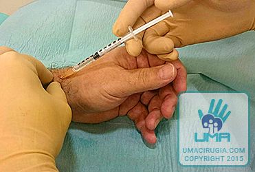 Cirugía de la mano en la Unidad de la Mano de A Coruña: tratamiento mediante férula e infiltración con corticoides.