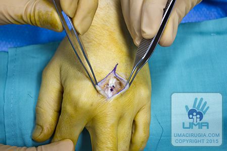 Cirugía de la mano en la Unidad de la Mano de A Coruña: sutura tendinosa (tenorrafia) mediante una sutura central en 