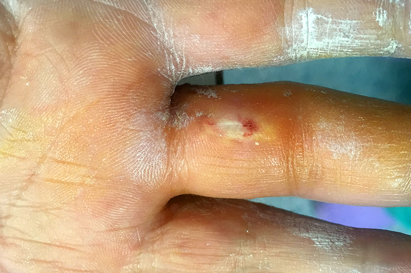 Pequeña herida de 5mm en la cara palmar de la falange proximal del 3er dedo