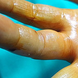 Zona de entrada de una espina en el borde radial del dedo