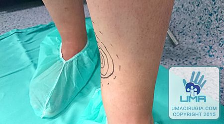 Cirugía de la mano en la Unidad de la Mano de A Coruña: Defecto en la cara interna de la pierna, anestesia y signo de Tinel
