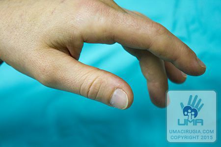 Cirugía de la mano en la Unidad de la Mano de A Coruña: deficit de extensión activa de la articulación metacarpofalangica, con extensión conservada de la articulación interfalangica proximal (IFP) y distal (IFD)