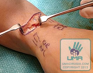 Cirugía de la mano en la Unidad de la Mano de A Coruña:identificado el nervio, se protege para evitar lesionarlo y se continua la disección