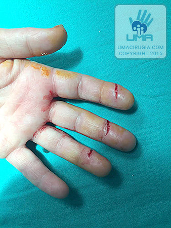 Casos Clinicos de la Unidad de Cirugía de la Mano A Coruña: Cortes en la cara volar de 2º, 3º y 4º dedos de la mano izquierda
