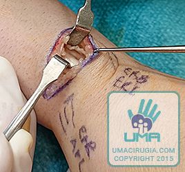 Cirugía de la mano en la Unidad de la Mano de A Coruña:Se liberan los tendones del ERL y ERB y se finaliza con la extirpación del tejido inflamatorio