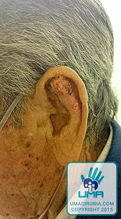 Cirugía de la mano en la Unidad de la Mano de A Coruña: Carcinoma epidermoide