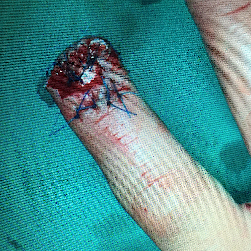 Unidad Cirugia Mano Coruna Galicia AMPUTACIONES corte de dedo con cortafiambre 1